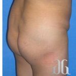 Buttock Augmentation Before & After Patient #7531