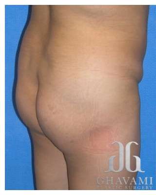 Buttock Augmentation Before & After Patient #7531