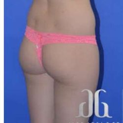 Buttock Augmentation Before & After Patient #7528
