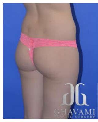 Buttock Augmentation Before & After Patient #7528