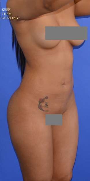 Buttock Augmentation Before & After Patient #7525