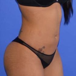 Buttock Augmentation Before & After Patient #7522