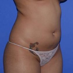 Buttock Augmentation Before & After Patient #7522