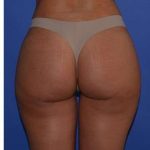 Buttock Augmentation Before & After Patient #7519