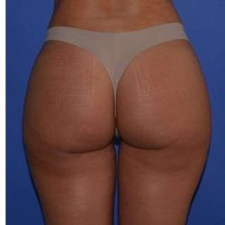 Buttock Augmentation Before & After Patient #7519