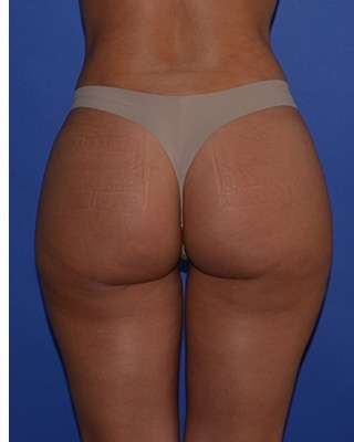 Buttock Augmentation Before & After Patient #7519
