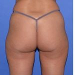 Buttock Augmentation Before & After Patient #7519
