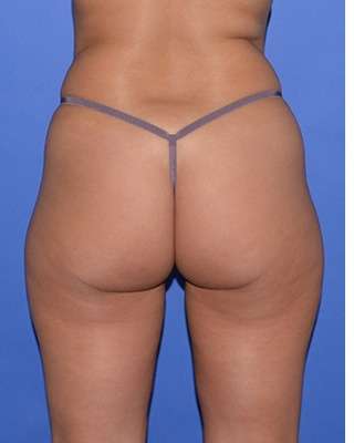Buttock Augmentation Before & After Patient #7519
