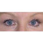 Blepharoplasty Before & After Patient #8090