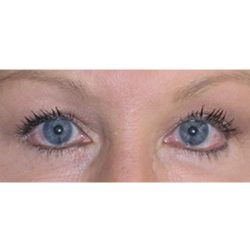 Blepharoplasty Before & After Patient #8090