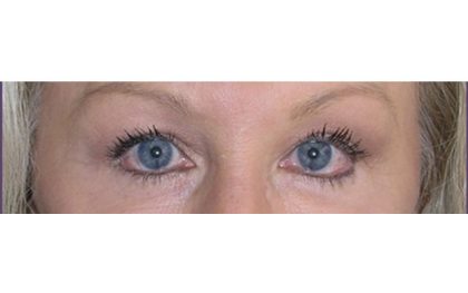 Blepharoplasty Before & After Patient #8090