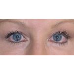 Browlift Before & After Patient #7770