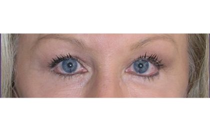 Browlift Before & After Patient #7770