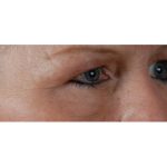Blepharoplasty Before & After Patient #8090