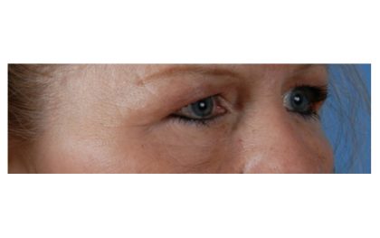 Blepharoplasty Before & After Patient #8090