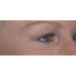 Blepharoplasty Before & After Patient #8090