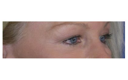 Blepharoplasty Before & After Patient #8090