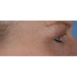 Blepharoplasty Before & After Patient #8090