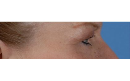 Blepharoplasty Before & After Patient #8090