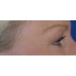 Blepharoplasty Before & After Patient #8090