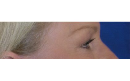 Blepharoplasty Before & After Patient #8090