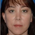Regenelift™ Facelift Before & After Patient #7504