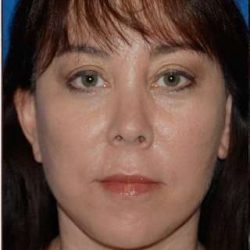 Regenelift™ Facelift Before & After Patient #7504