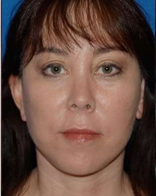 Regenelift™ Facelift Before & After Patient #7504