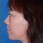 Regenelift™ Facelift Before & After Patient #7504