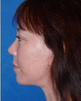 Regenelift™ Facelift Before & After Patient #7504