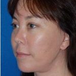 Regenelift™ Facelift Before & After Patient #7504
