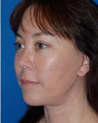 Regenelift™ Facelift Before & After Patient #7504