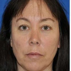 Regenelift™ Facelift Before & After Patient #7504