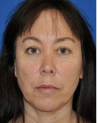 Regenelift™ Facelift Before & After Patient #7504