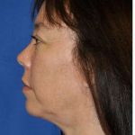 Regenelift™ Facelift Before & After Patient #7504