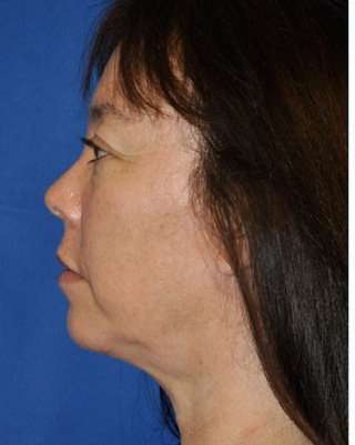 Regenelift™ Facelift Before & After Patient #7504