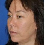 Regenelift™ Facelift Before & After Patient #7504