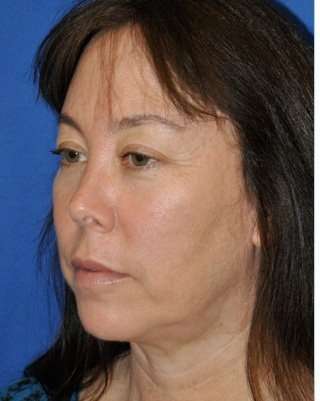 Regenelift™ Facelift Before & After Patient #7504