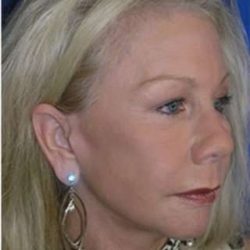 Regenelift™ Facelift Before & After Patient #7497