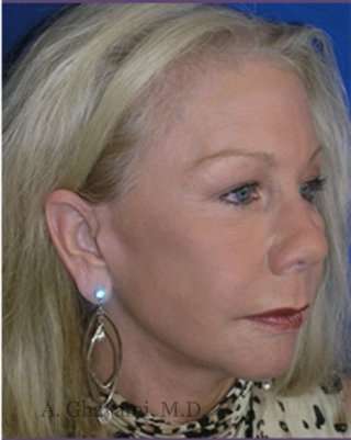 Regenelift™ Facelift Before & After Patient #7497