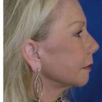 Regenelift™ Facelift Before & After Patient #7497