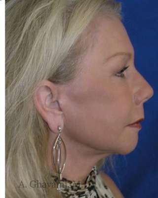 Regenelift™ Facelift Before & After Patient #7497