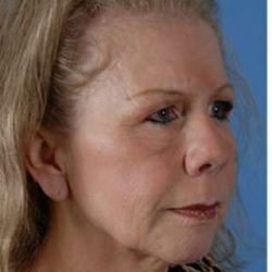 Regenelift™ Facelift Before & After Patient #7497