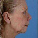 Regenelift™ Facelift Before & After Patient #7497