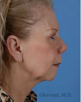 Regenelift™ Facelift Before & After Patient #7497