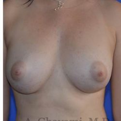 Fat Transfer To Breast Before & After Patient #8265