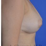 Fat Transfer To Breast Before & After Patient #8265