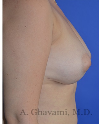 Fat Transfer To Breast Before & After Patient #8265