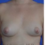 Fat Transfer To Breast Before & After Patient #8265