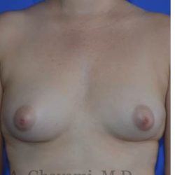 Fat Transfer To Breast Before & After Patient #8265